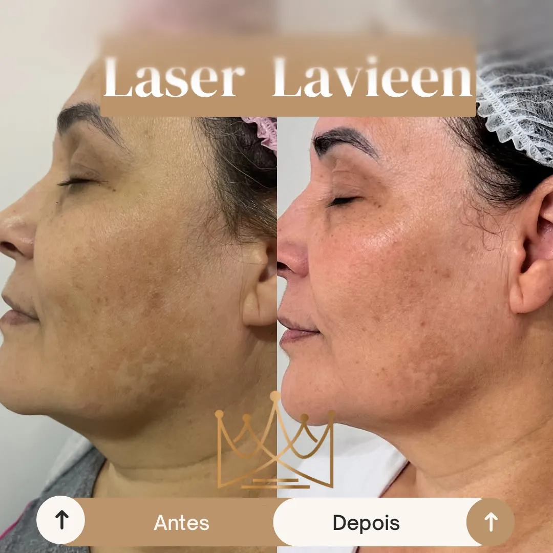 Laser Lavieen